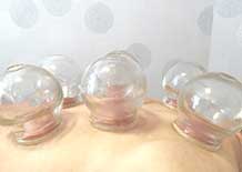 person receiving cupping therapy - provided by BlueWhite Health